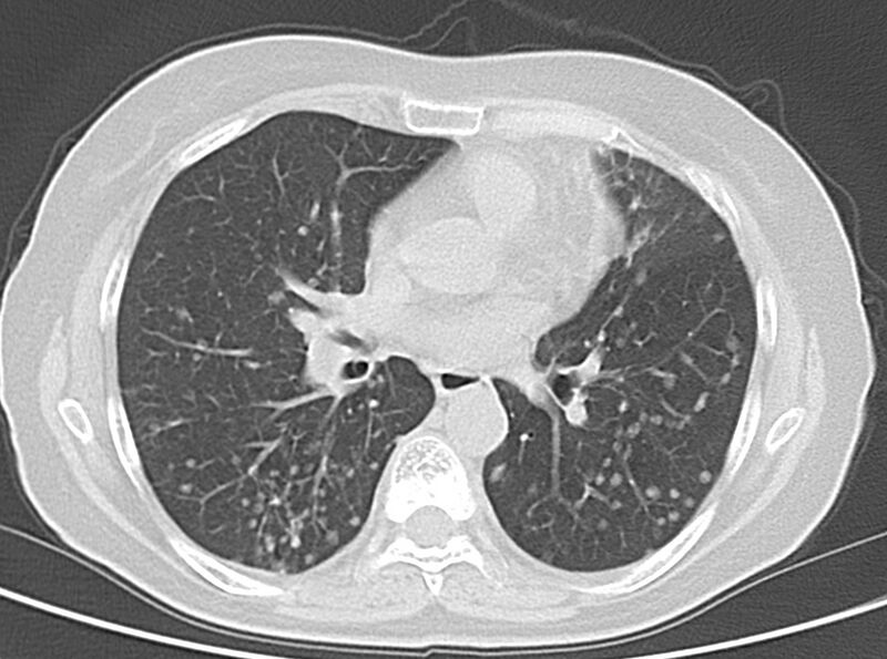 File:Adenosquamous lung carcinoma (Radiopaedia 22035-22030 lung window 34).jpg