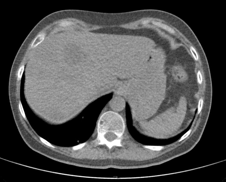 File:Adenosquamous lung carcinoma (Radiopaedia 22035-22030 non-contrast 53).jpg