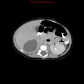 Adrenal hemorrhage (Radiopaedia 9390-10077 Axial C+ portal venous phase 10).jpg