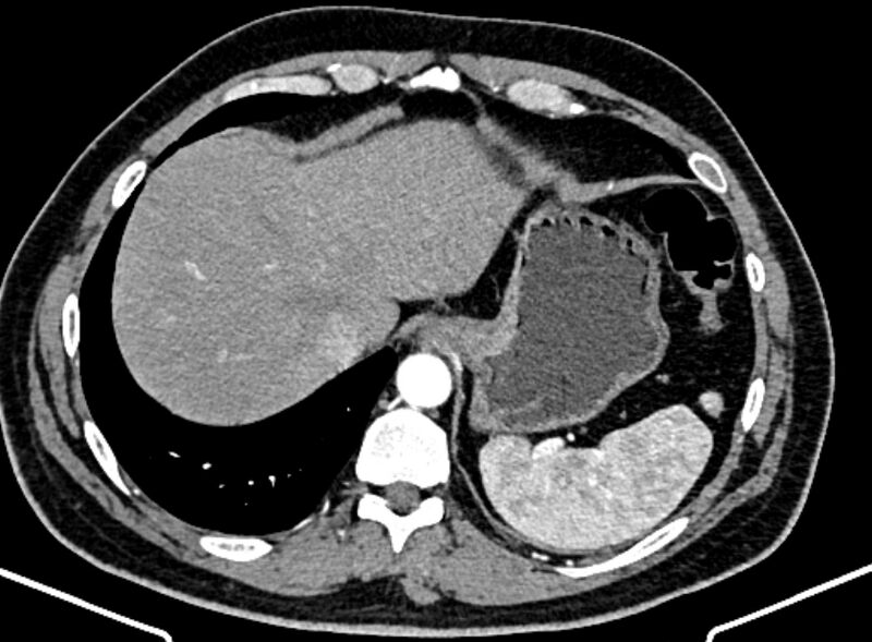 File:Adrenal metastases (Radiopaedia 73082-83791 Axial C+ arterial phase 23).jpg