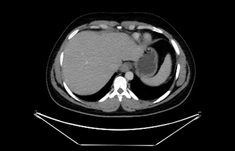 File:Adrenocortical carcinoma (Radiopaedia 80134-93438 Axial C+ portal venous phase 22).jpg