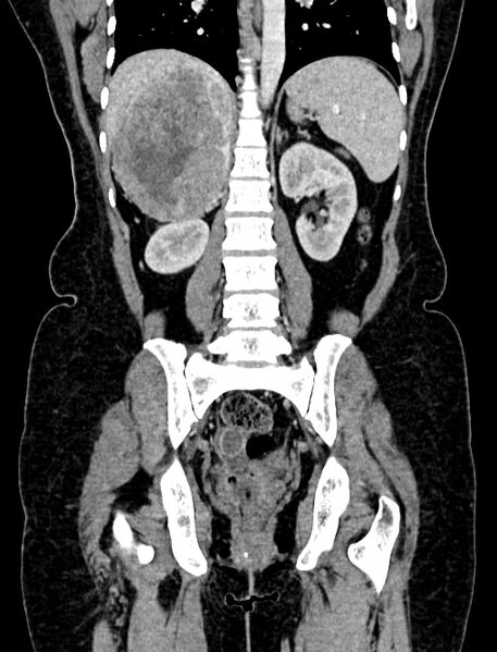 File:Adrenocortical carcinoma (Radiopaedia 87281-103569 Coronal C+ portal venous phase 84).jpg