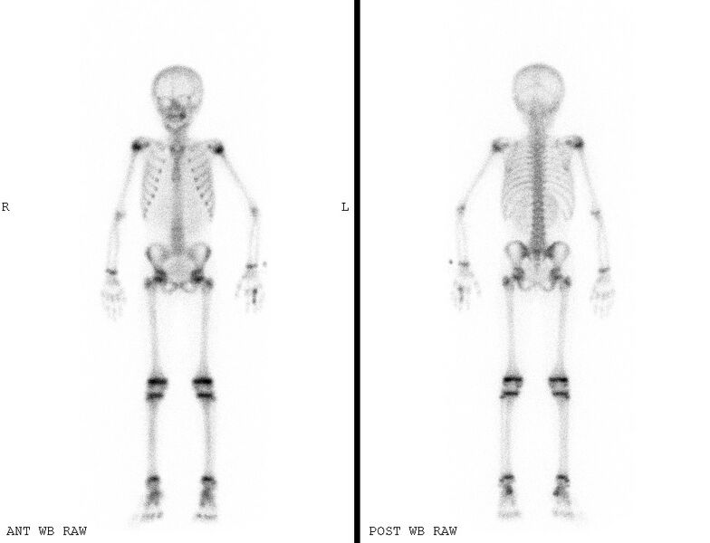 File:Adrenocortical carcinoma (Radiopaedia 9449-10132 Whole body Anterior and Posterior views isotope bone scan. 1).jpg