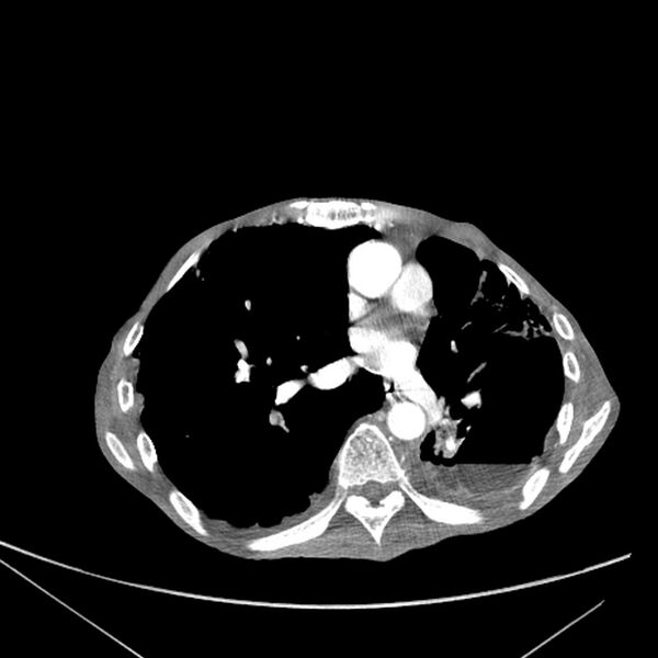 File:Advanced pulmonary tuberculosis (Radiopaedia 8599-9431 Axial liver window 11).jpg