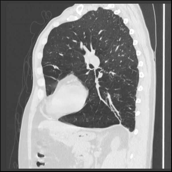 File:Alpha-1-antitrypsin deficiency (Radiopaedia 40993-43722 Sagittal lung window 101).jpg