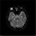 Amnestic syndrome secondary to hypoxic brain injury (Radiopaedia 24743-25004 DWI 43).jpg