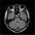 Amnestic syndrome secondary to hypoxic brain injury (Radiopaedia 24743-25004 FLAIR 6).jpg