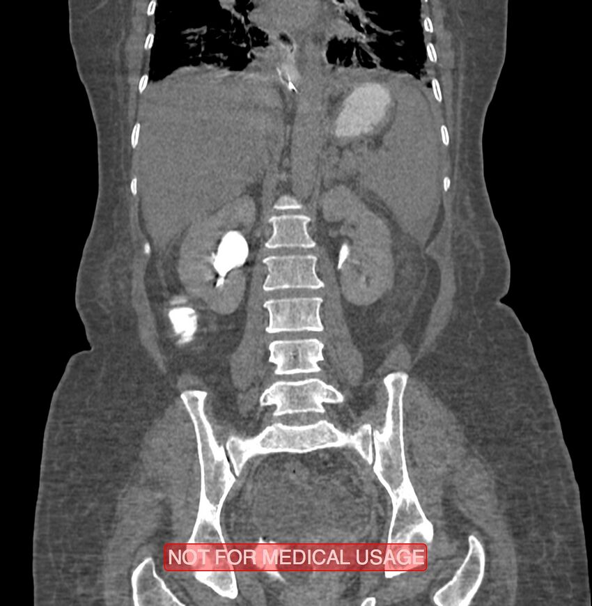 Amoebic enterocolitis with liver abscess (Radiopaedia 35100-36609 B 130).jpg