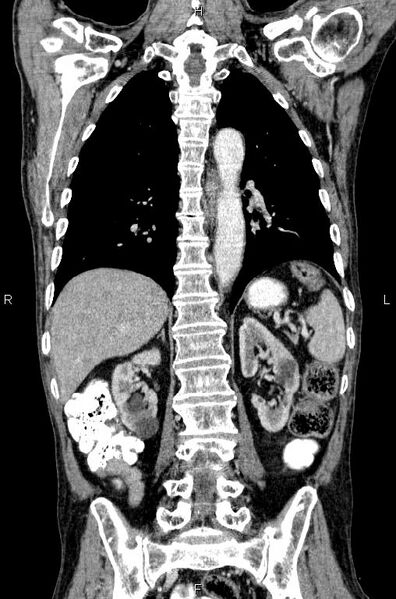 File:Ampullary adenocarcinoma (Radiopaedia 86093-102033 D 41).jpg