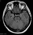 Amyotrophic lateral sclerosis (Radiopaedia 5373-7134 Axial FLAIR 9).jpg
