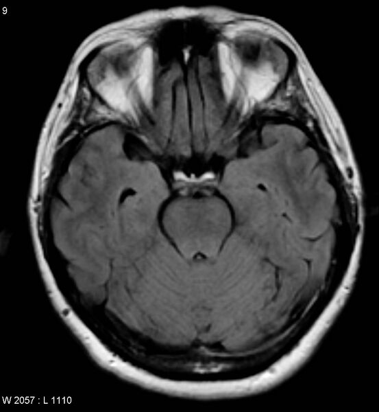 File:Amyotrophic lateral sclerosis (Radiopaedia 5373-7134 Axial FLAIR 9).jpg