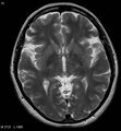 Amyotrophic lateral sclerosis (Radiopaedia 5373-7134 Axial T2 12).jpg