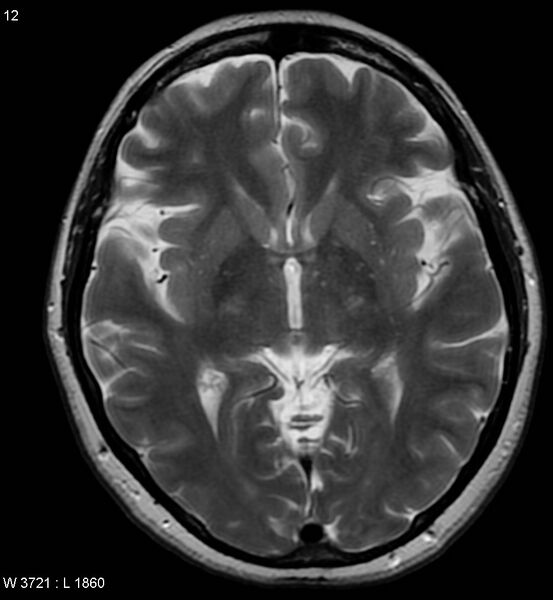 File:Amyotrophic lateral sclerosis (Radiopaedia 5373-7134 Axial T2 12).jpg