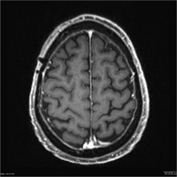 File:Anaplastic meningioma with recurrence (Radiopaedia 34452-35788 Axial T1 C+ 120).jpg