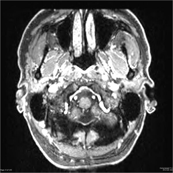 File:Anaplastic meningioma with recurrence (Radiopaedia 34452-35788 Axial T1 C+ 8).jpg