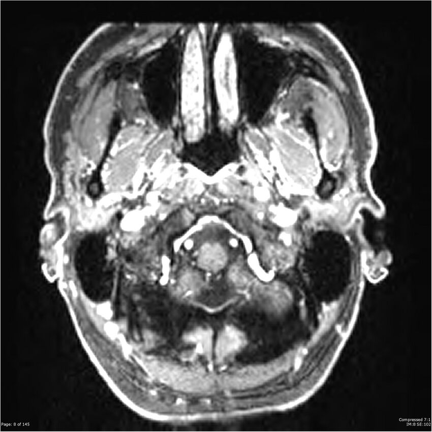 Anaplastic meningioma with recurrence (Radiopaedia 34452-35788 Axial T1 C+ 8).jpg