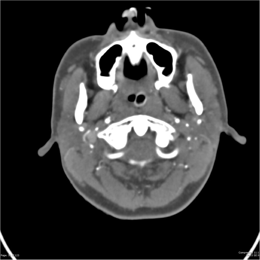 Aneurysmal subarachnoid hemorrhage and Moya Moya disease (Radiopaedia 34306-35593 Axial CT COW 53).jpg