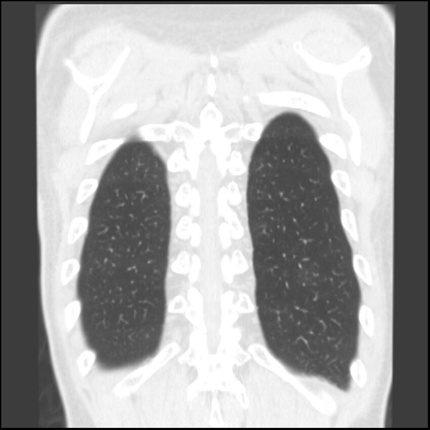 Angioinvasive aspergillosis (Radiopaedia 43957-47466 Coronal lung window 10).jpg