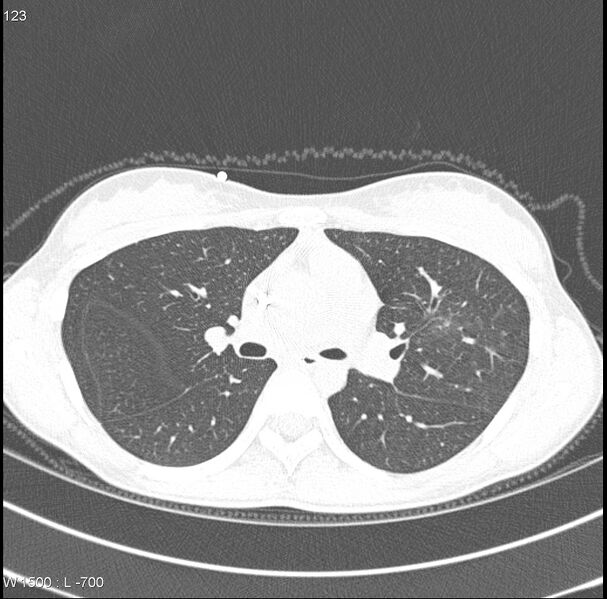 File:Angioinvasive aspergillosis (Radiopaedia 8651-15074 Axial lung window 1).jpg