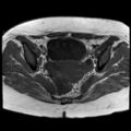 Ano-vaginal fistula (Radiopaedia 29765-30284 Axial T1 19).jpg