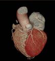 Anomalous left coronary artery- prepulmonic course (Radiopaedia 29253-29667 3D VRT 4).JPG