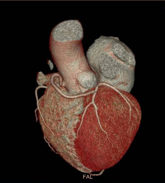 File:Anomalous left coronary artery- prepulmonic course (Radiopaedia 29253-29667 3D VRT 4).JPG