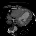 Anomalous left coronary artery from the pulmonary artery (ALCAPA) (Radiopaedia 40884-43586 A 64).jpg