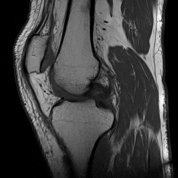 File:Anterior cruciate ligament tear - ramp lesion (Radiopaedia 71883-82322 Sagittal T1 15).jpg