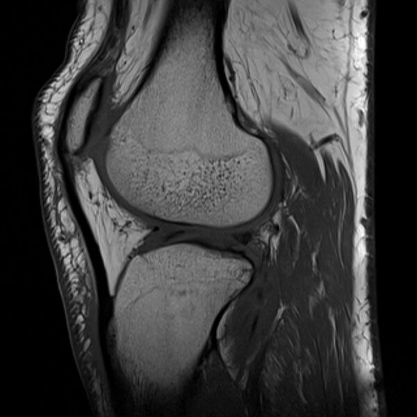 File:Anterior cruciate ligament tear - ramp lesion (Radiopaedia 71883-82322 Sagittal T1 9).jpg