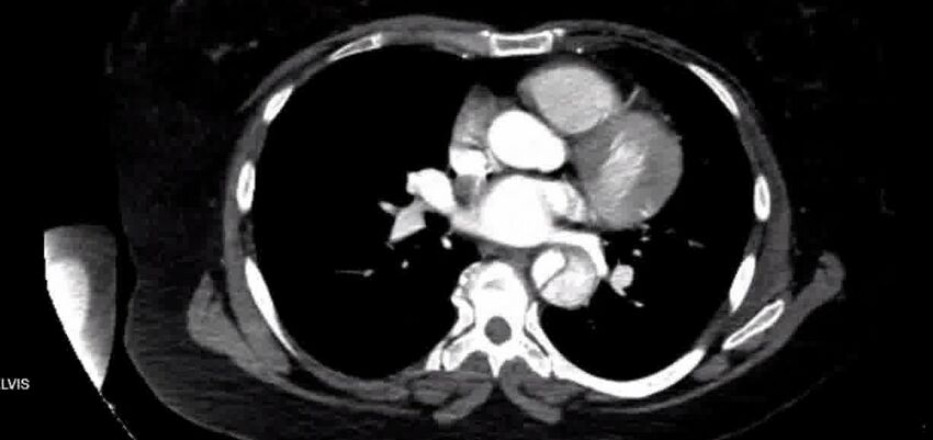 Aortic Dissection (Radiopaedia 85272-100847 A 25).jpg