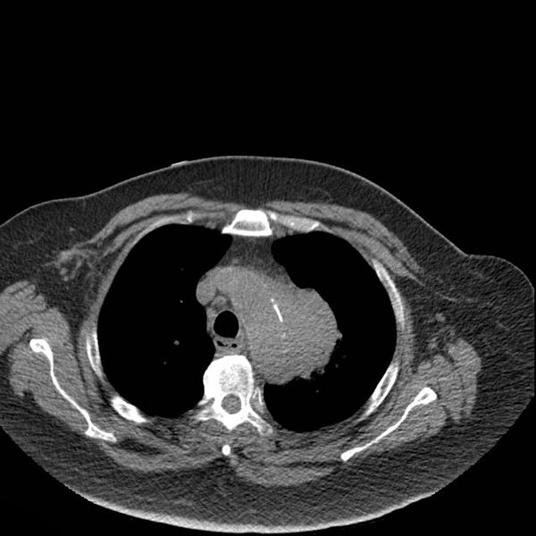 File:Aortic arch false aneurysm (Radiopaedia 14667-14587 Axial non-contrast 8).jpg