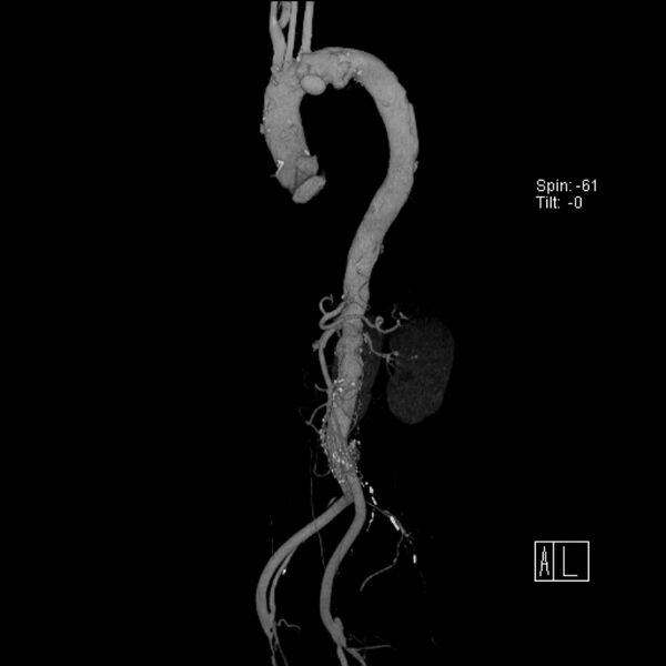 File:Aortic arch saccular aneurysm (Radiopaedia 19430-19457 A 4).jpg