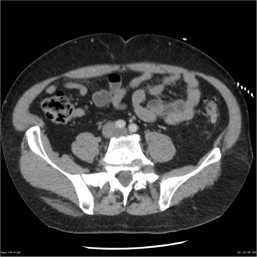 Aortic dissection- Stanford A (Radiopaedia 37759-39664 A 135).jpg