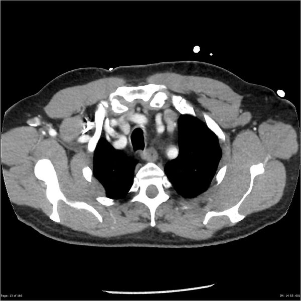 File:Aortic dissection- Stanford A (Radiopaedia 37759-39664 A 4).jpg