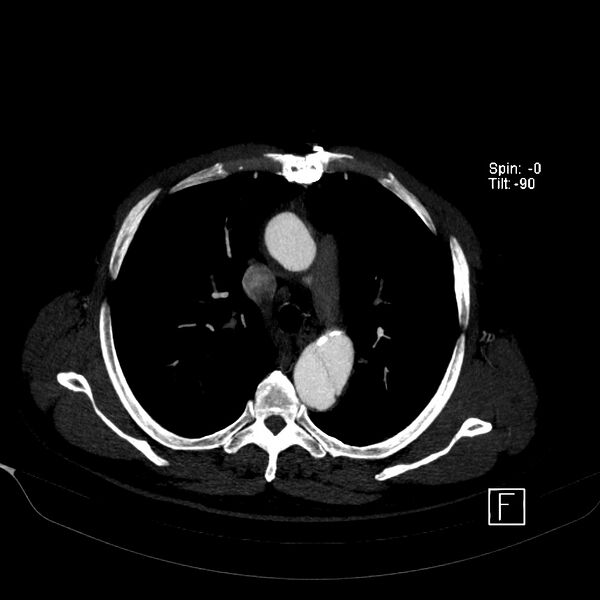 File:Aortic dissection - De Bakey type III - Stanford B (Radiopaedia 21903-21882 B 21).jpg
