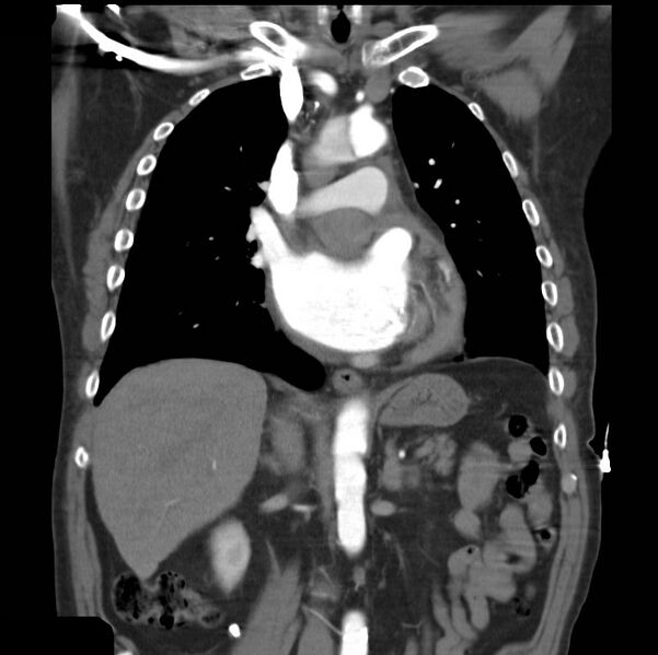 File:Aortic dissection with rupture into pericardium (Radiopaedia 12384-12647 B 20).jpg
