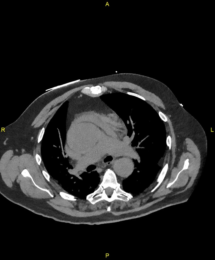 Aortic rupture (Radiopaedia 88822-105594 Axial non-contrast 85).jpg