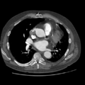 Aorto-coronary bypass graft aneurysms (Radiopaedia 40562-43157 A 63).png