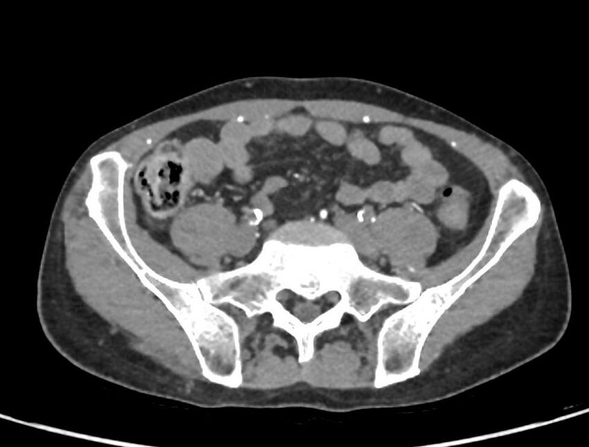 Aortoiliac occlusive disease (Radiopaedia 89182-106053 A 47).jpg