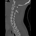 Apical pneumothorax on cervical spine CT (Radiopaedia 45343-49368 Sagittal bone window 22).jpg