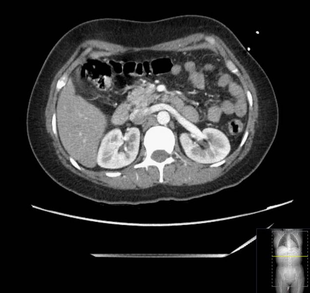 File:Appendicitis (CT angiogram) (Radiopaedia 154713-127660 Axial 129).jpg