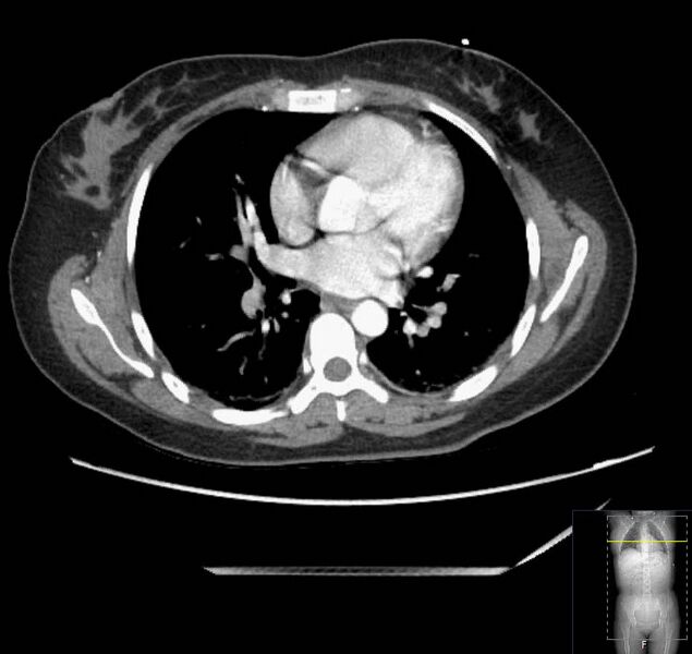 File:Appendicitis (CT angiogram) (Radiopaedia 154713-127660 Axial 197).jpg