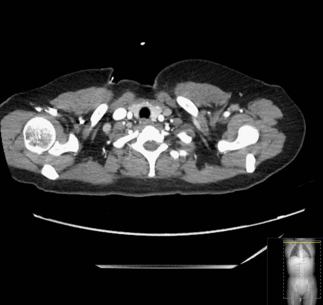 File:Appendicitis (CT angiogram) (Radiopaedia 154713-127660 Axial 241).jpg