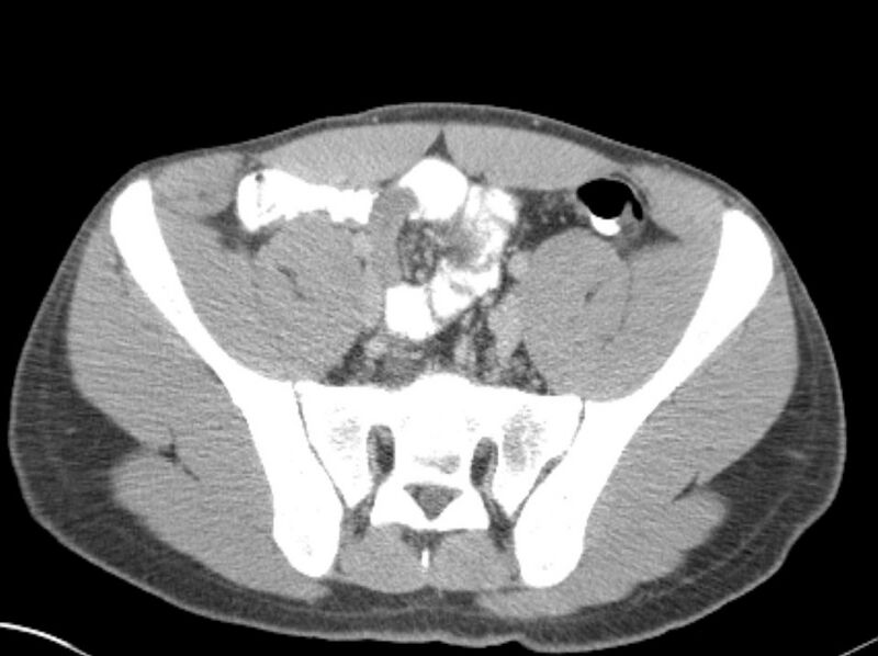 File:Appendicitis and incidental foregut duplication cyst (Radiopaedia 52962-58916 A 71).jpg