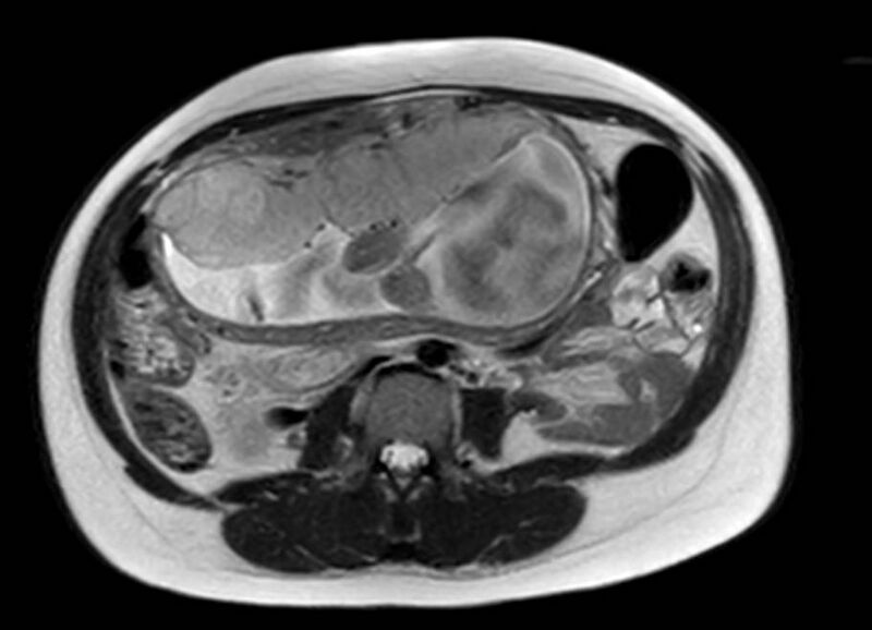 File:Appendicitis in gravida (MRI) (Radiopaedia 89433-106395 Axial T2 34).jpg