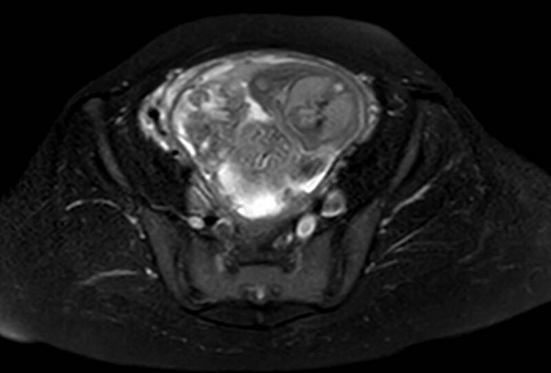 File:Appendicitis in gravida (MRI) (Radiopaedia 89433-106395 Axial T2 SPAIR 59).jpg