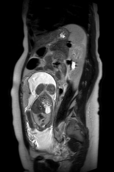 File:Appendicitis in gravida (MRI) (Radiopaedia 89433-106395 Sagittal T2 25).jpg