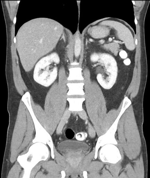 File:Appendicitis with cecal bar sign (Radiopaedia 31878-32830 A 37).jpg