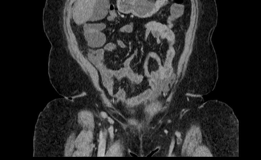 Appendix mucocele (Radiopaedia 41222-44033 B 11).jpg