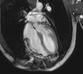 Arrhythmogenic right ventricular cardiomyopathy (Radiopaedia 39806-42237 D 21).jpg
